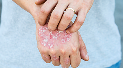Psoriasis